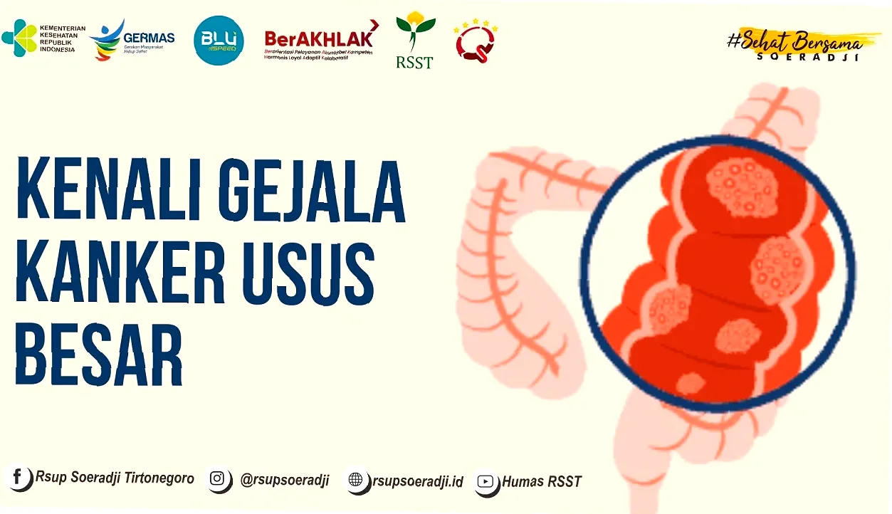 gejala kanker usus besar