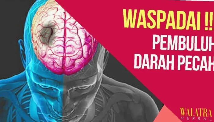 Obat Penyumbatan Pembuluh Darah Otak Ampuh!  Cara Cepat Pulih!