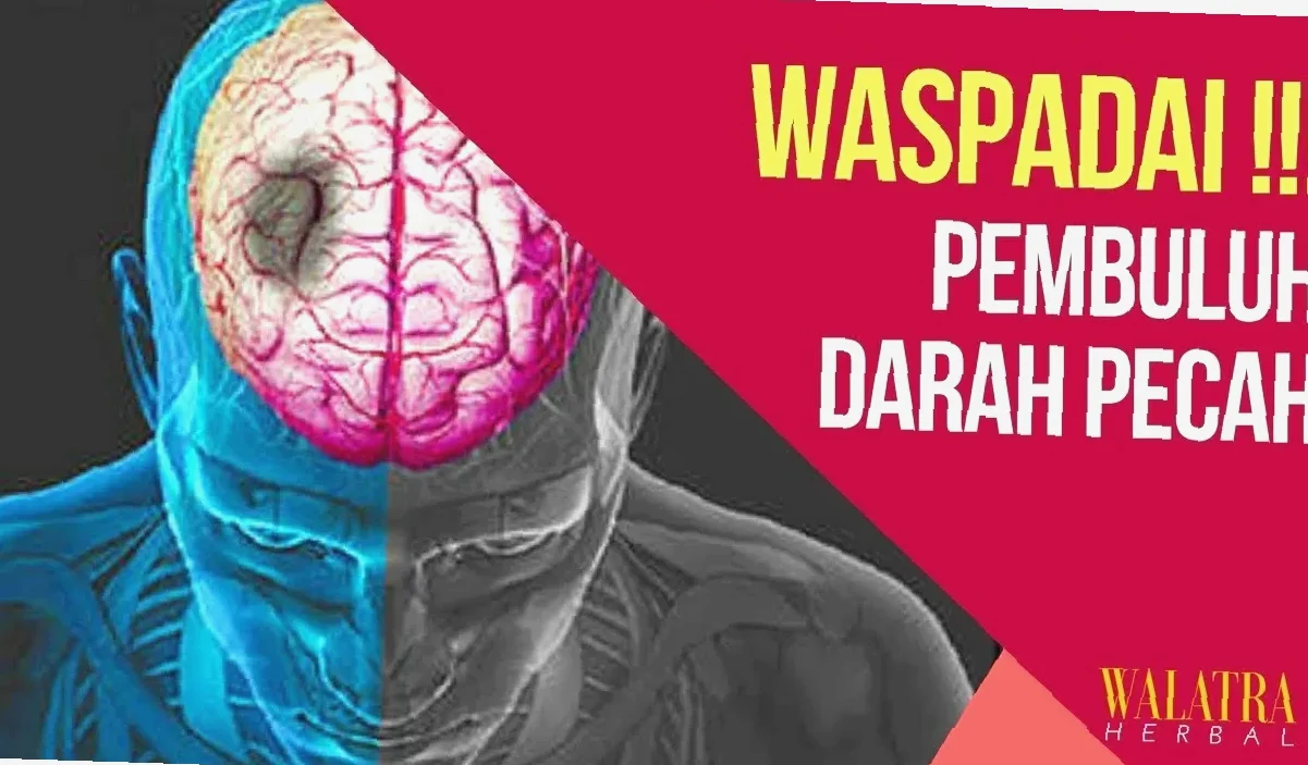 obat penyumbatan pembuluh darah otak