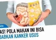 penyebab kanker usus besar