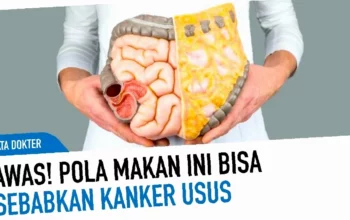 penyebab kanker usus besar