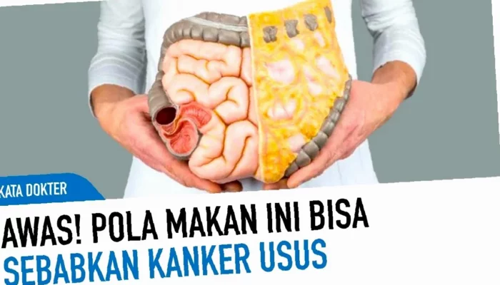 Rahasia Kanker Usus Besar Terungkap!  Mengenal Penyebab & Pencegahan