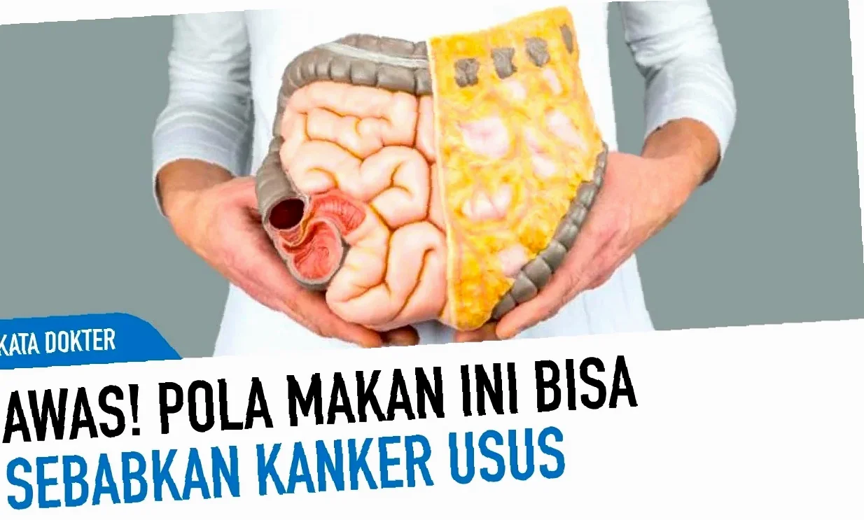 penyebab kanker usus besar