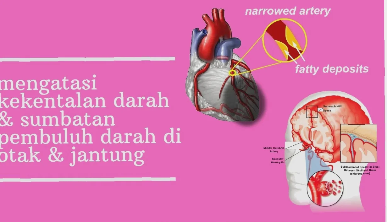 penyumbatan pembuluh darah otak