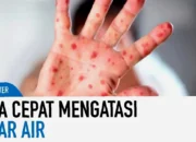Cepat!  Cara Aman Mengatasi Virus Hanta,  Dijamin Sembuh