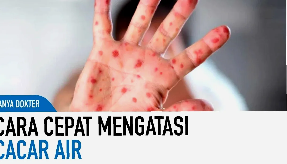 bagaimana cara mengobati virus hanta