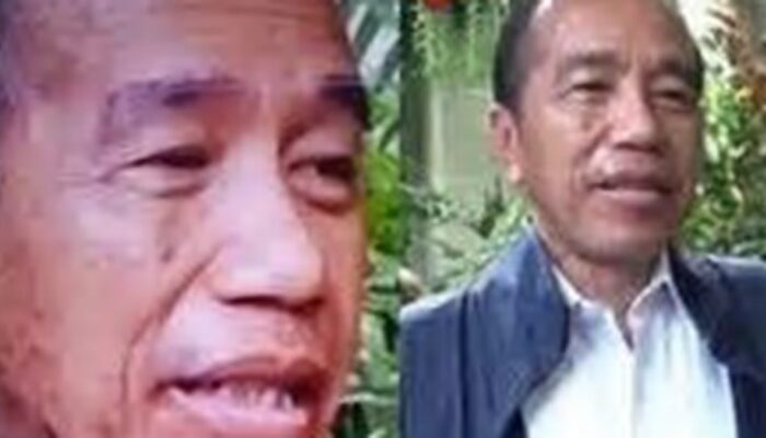 Mantan Presiden Jokowi Dikabarkan Mengalami Reaksi Kulit Parah, Terkait Sindrom Stevens-Johnson (SJS)