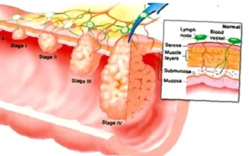 biomarker kanker usus