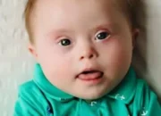 Pengobatan Down Syndrome