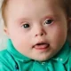 Pengobatan Down Syndrome