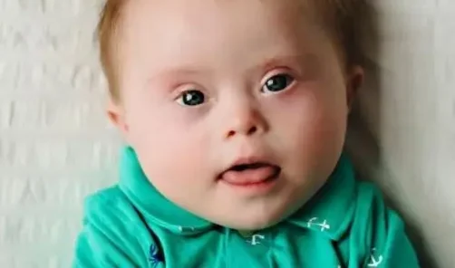 Pengobatan Down Syndrome