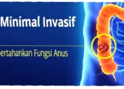Jangan Lewatkan, Penelitian Terbaru Kanker Usus, Rahasia Deteksi Dini & Terobosan Pengobatan yang Bisa Selamatkan Hidup Anda