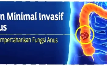 penelitian terbaru kanker usus