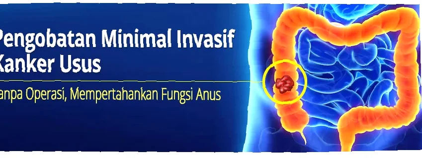 penelitian terbaru kanker usus