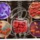 peran diet mikrobiota & prebiotik di kanker usus
